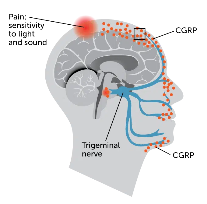 Migraine Treatment in Beverly Hills 4 032721 migrane inline 3 680 rev